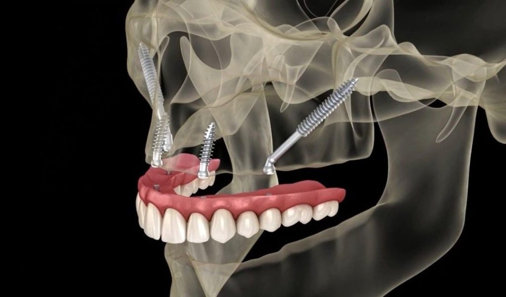 Implant placement in the pterygoid region of the maxilla — anatomical positioning