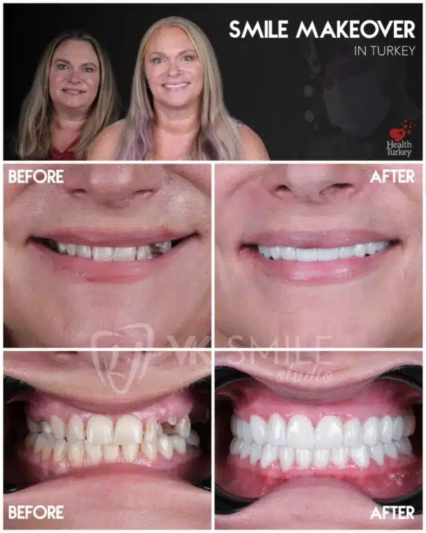 Smile makeover in Turkey