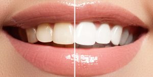 Teeth Whitening