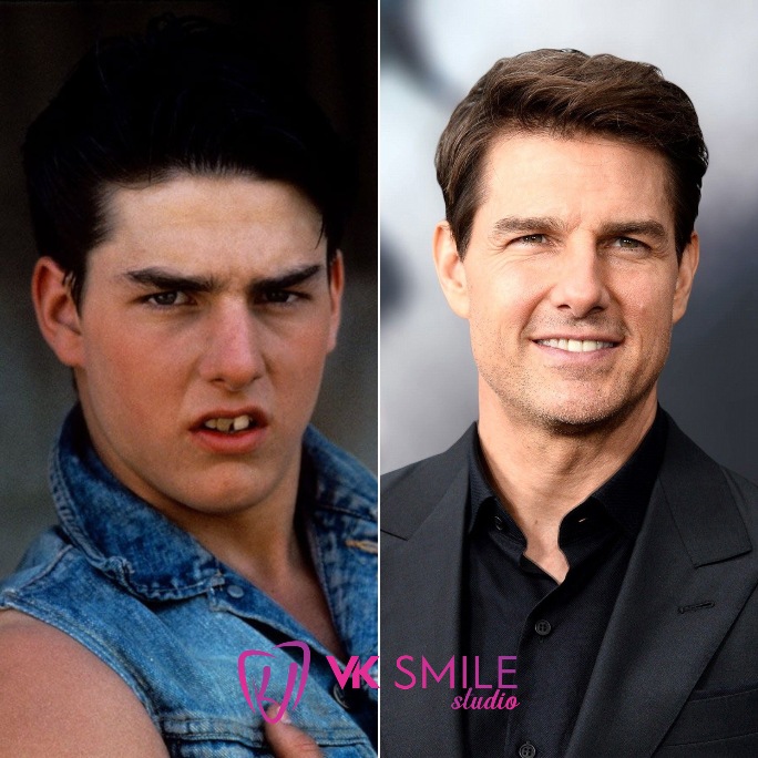 Tom Cruise teeth