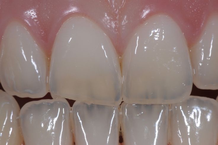 tooth transparency
