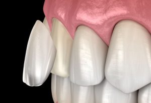 Veneers without shaving teeth in Turkey