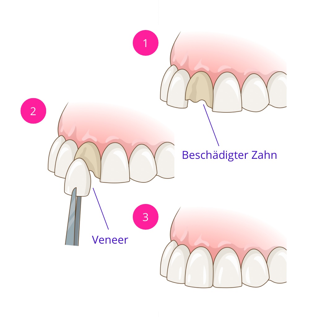 Een schematische weergave van de procedure voor het aanbrengen van fineer
