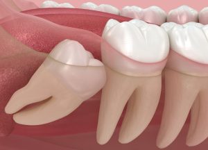 Wisdom Teeth