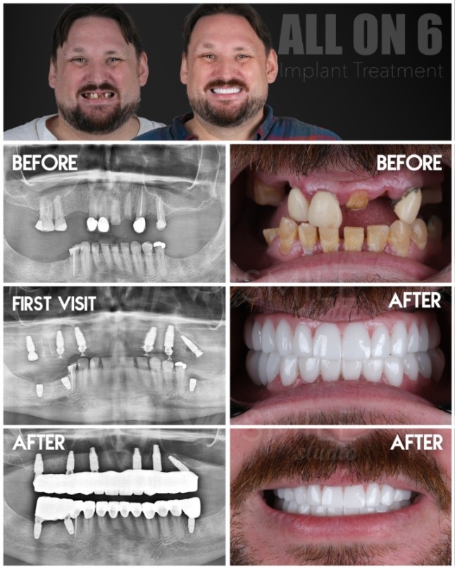 All-on-6-Implantate in der Türkei