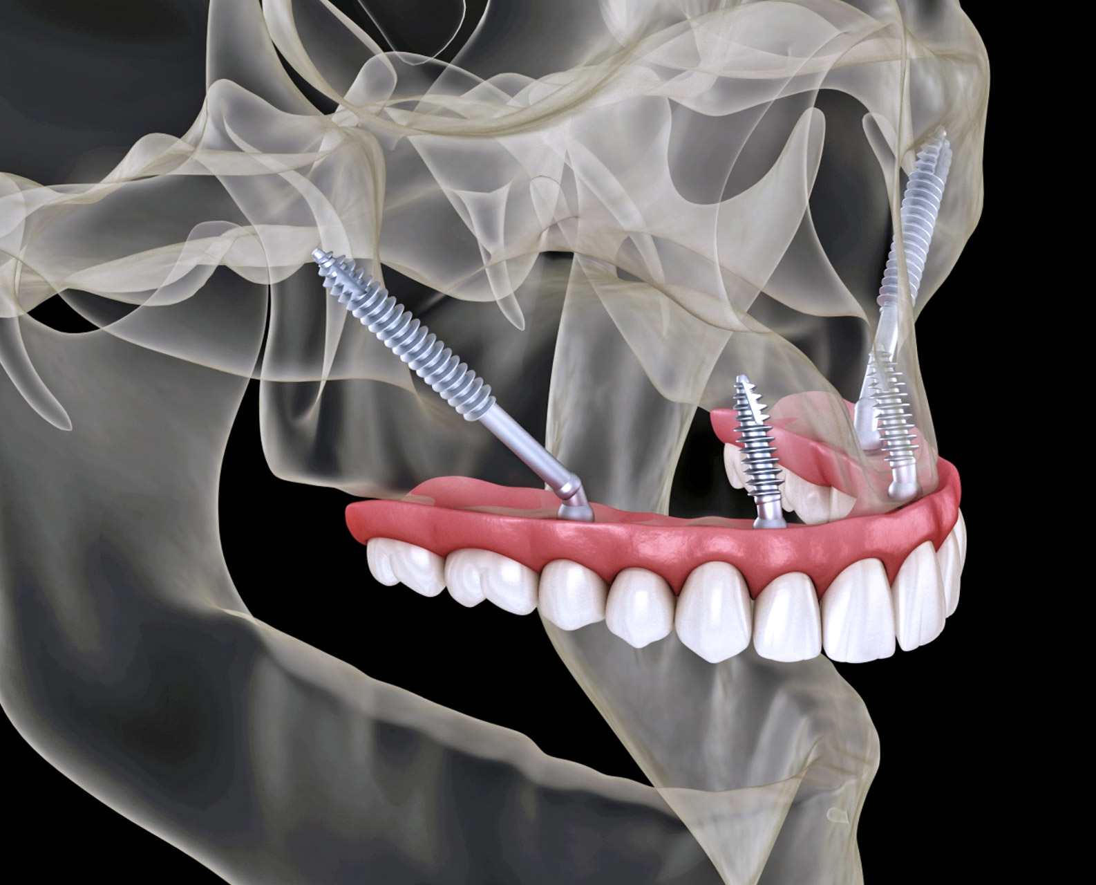 Zygomatic Dental Implants Cost and Benefits in Turkey