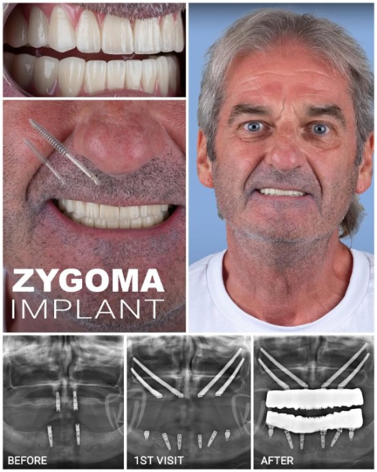 Zygomatic and All-on-6 dental implants in Turkey for patients with severe bone loss